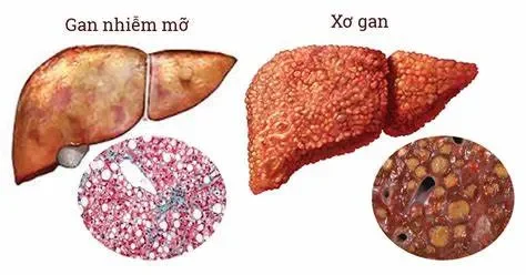 Ăn gì để giảm gan nhiễm mỡ độ 2?