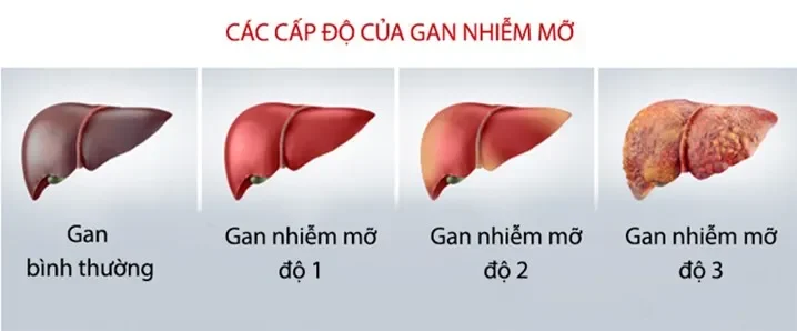 bệnh gan nhiễm mỡ độ 2 kiêng ăn gì​