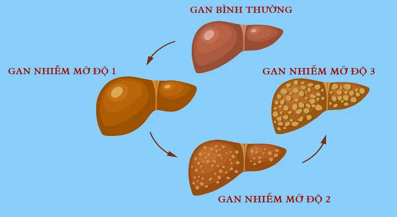 cách điều trị gan nhiễm mỡ độ 1​