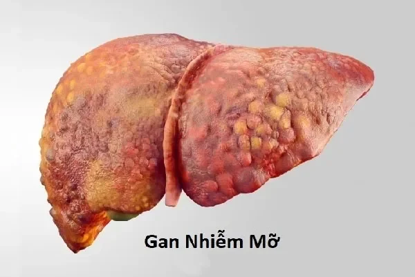 Chia sẻ từ người thật việc thật: Hành trình giảm cân và "tạm biệt" gan nhiễm mỡ