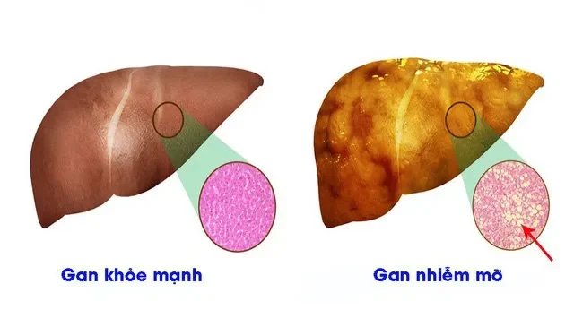 Curcumin là gì và cơ chế tác động của curcumin trong việc hỗ trợ điều trị gan nhiễm mỡ?