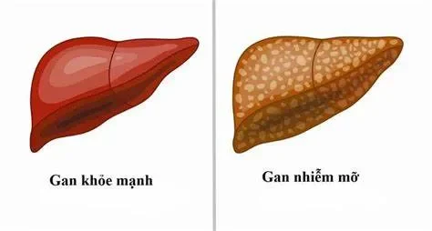 dấu hiệu bệnh gan nhiễm mỡ