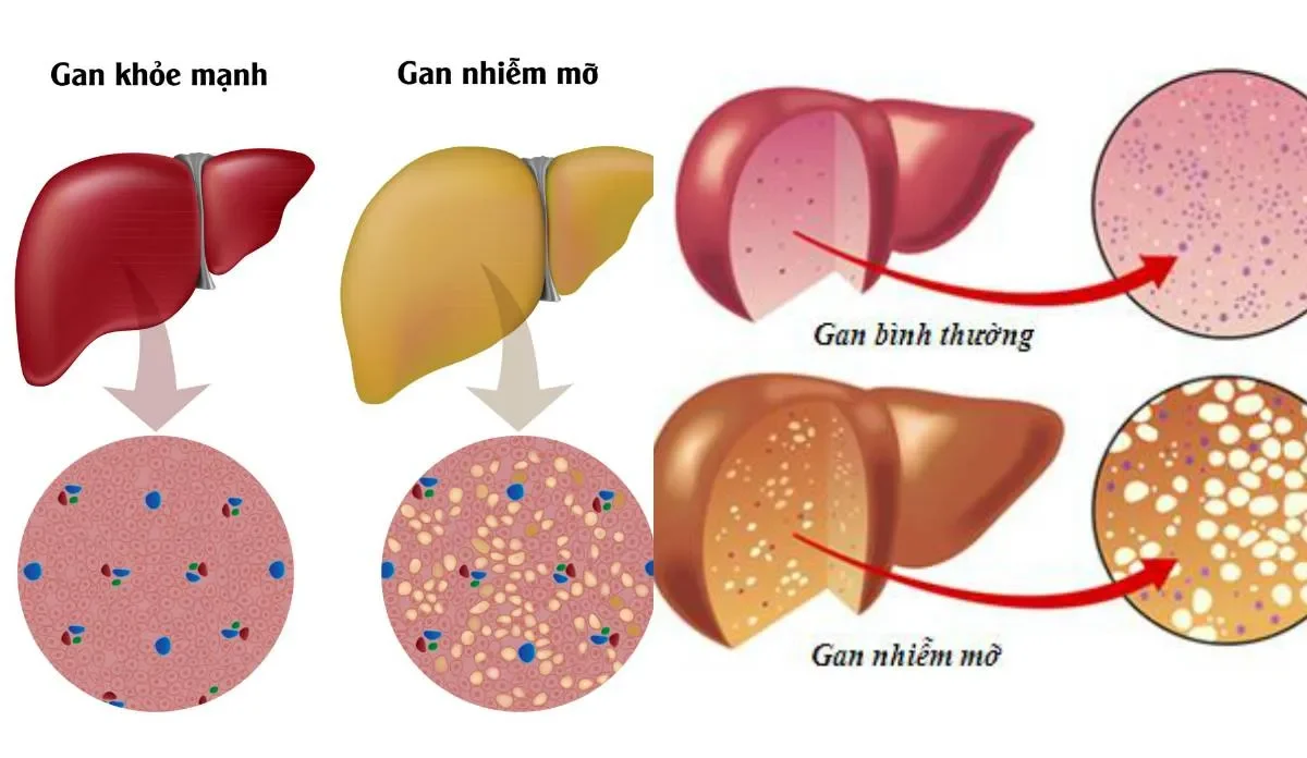 Gan nhiễm mỡ độ 1 có cần dùng thuốc không?