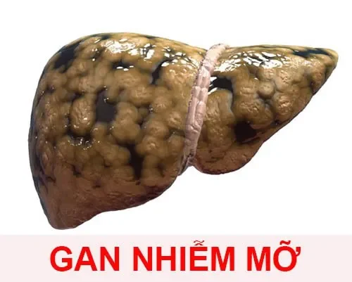 Gan nhiễm mỡ độ 1 là gì và bạn cần biết những gì?