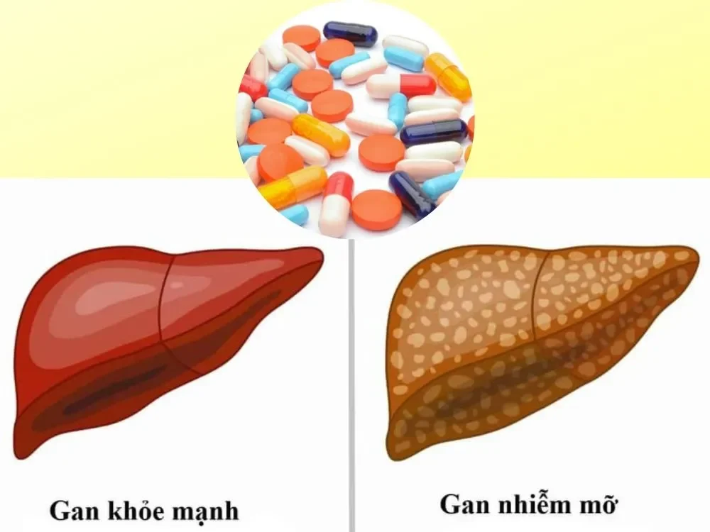 Gan nhiễm mỡ độ 2 là gì và mức độ nguy hiểm như thế nào?