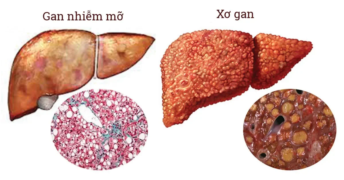 gan nhiễm mỡ độ 3 có chữa khỏi được không​