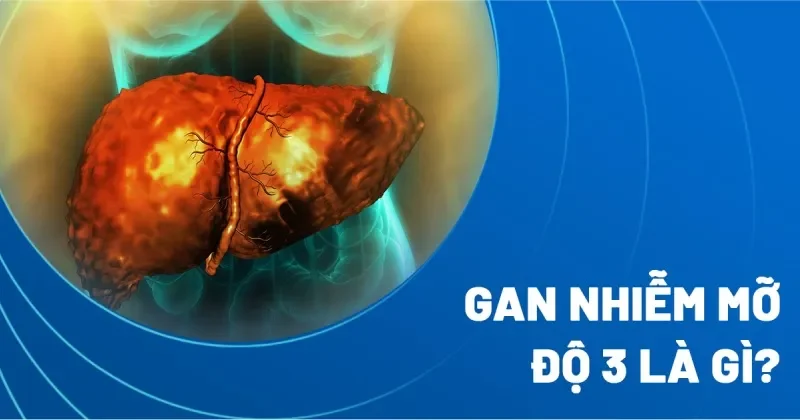 gan nhiễm mỡ độ 3​ là gì