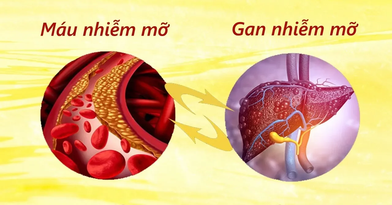 giảm cân có hết gan nhiễm mỡ không​