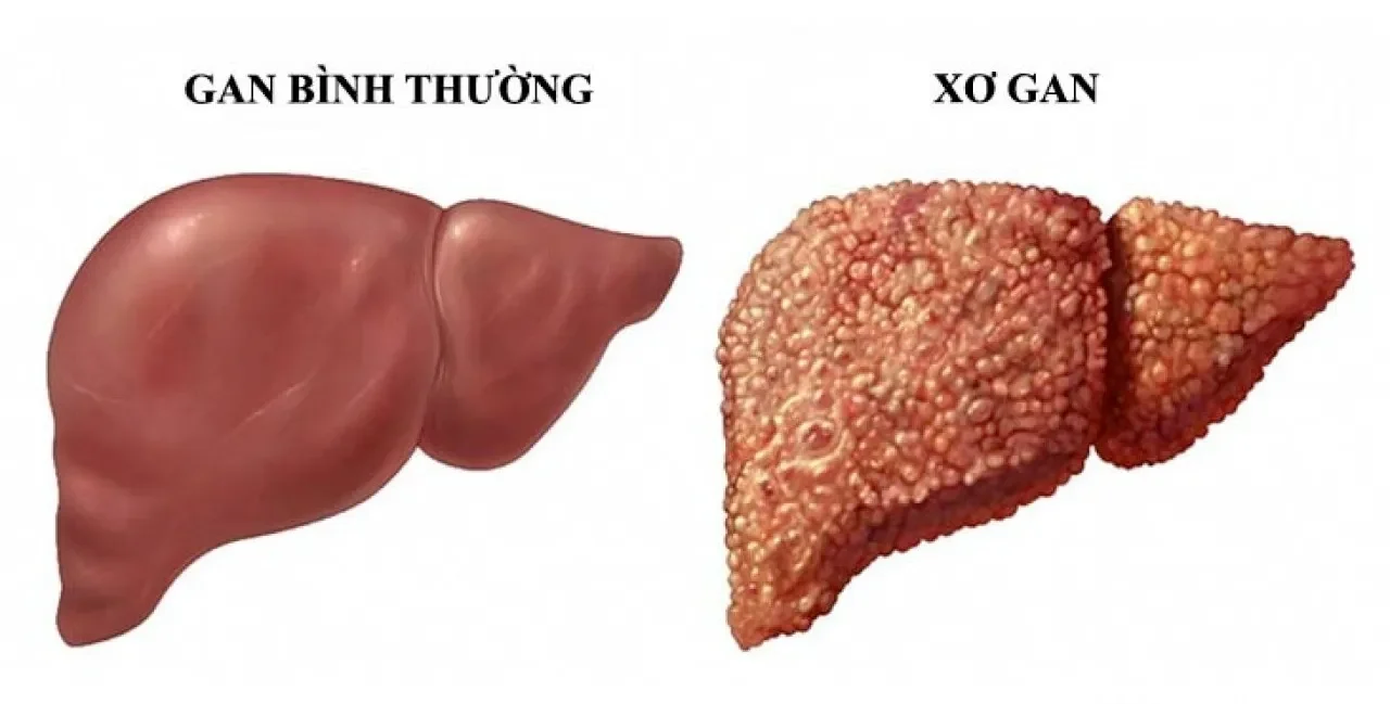 Kinh nghiệm phục hồi gan từ những người "trong cuộc"