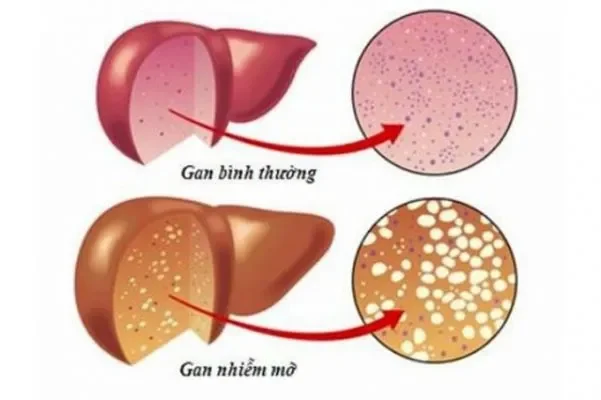 Làm sao biết mình có bị gan nhiễm mỡ không? Triệu chứng là gì?