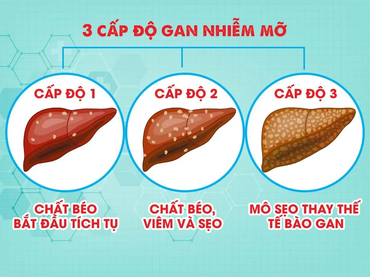 Tập luyện thể dục thể thao – "Liều thuốc" tự nhiên cho gan